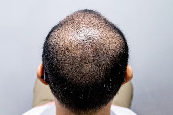 Non-Surgical Hair Replacement System in Singapore | For Men