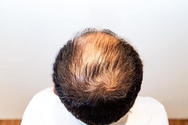 Non-Surgical Hair Replacement System in Singapore | For Men Non-Surgical Hair Replacement System in Singapore | For Men