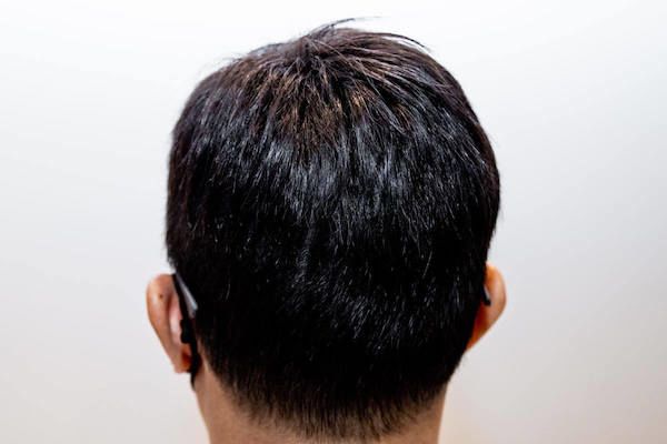 Non-Surgical Hair Replacement System in Singapore | For Men
